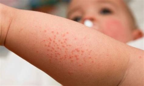 What To Do With A Rash Why Do Children Often Get A Rash When It Is Hot