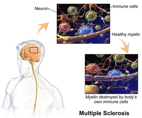 You may experience eye pain, blurred vision and headache. Using Hypnotherapy To Treat Multiple Sclerosis