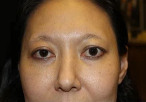 Graves' eye disease, also known as thyroid eye disease, is an autoimmune condition in which immune cells attack the thyroid gland which responds by secreting an excess amount of thyroid hormone. Treat Thyroid Eye Diease in Austin | Graves' Disease | Dr ...