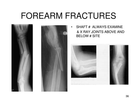 Ppt Common Fractures Powerpoint Presentation Free Download Id9700749
