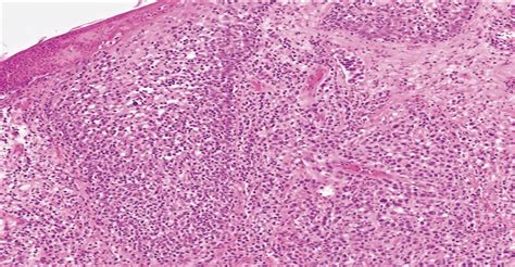 Primary Cutaneous Anaplastic Large Cell Lymphoma With 6p253 The