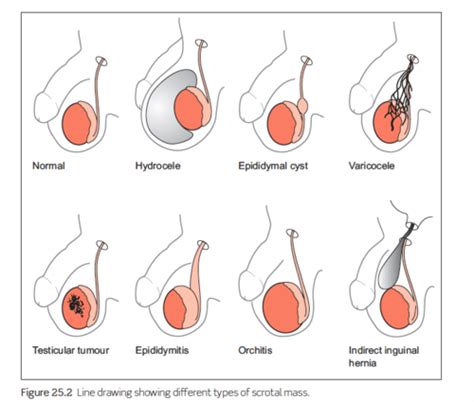 Epididymal Cyst Diagram