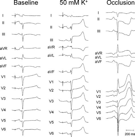 Changes in QRS duration and R-wave amplitude in electrocardiogram leads with ST segment ...