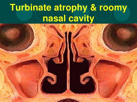Nasal Cavity Turbinate Bones Turbinate Bones Nasal Conchae The