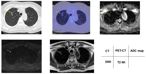Cancers Free Full Text Pulmonary Nodule And Mass Superiority Of