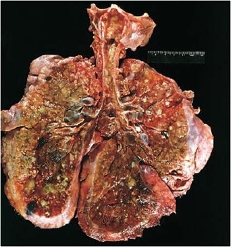 The most serious and common complications of cystic fibrosis are problems with the lungs, also. Genetic Disorders at University of Texas - Southwestern ...