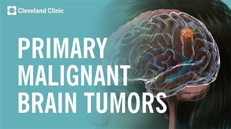 What Are Primary Malignant Brain Tumors Youtube