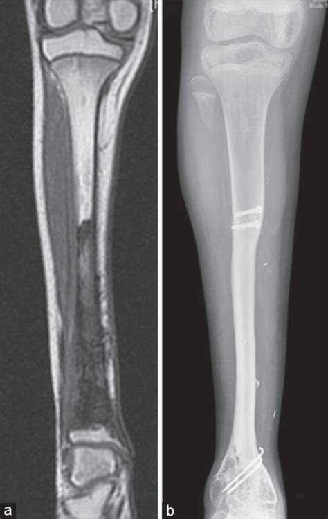 A Preoperative Magnetic Resonance Imaging Of Tibia Sh Open I