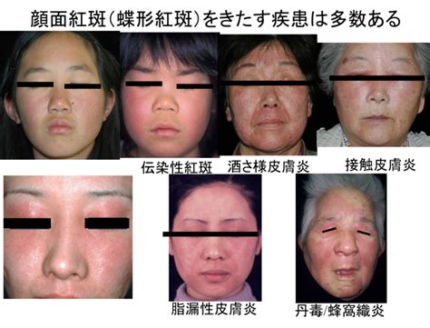 We did not find results for: 顔が赤い疾患（酒さ）（神戸三宮・皮膚科） | はやし皮ふ科 ...