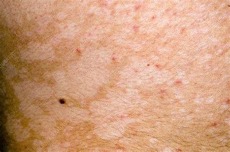 Pityriasis Versicolor Skin Infection Stock Image M2400717