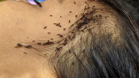 Removing A Lot Of Head Lice From Long Hair Get Out Big Head Lice From