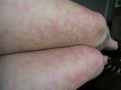 What Causes Blotchy Skin On Legs Blotchy Skin Red Skin Blotches