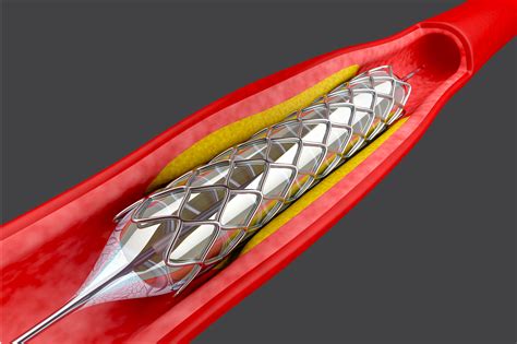 Coronary Angioplasty Stent Insertion Procedure Risks And Benefits