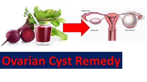 How To Get Rid Of Ovarian Cysts At Home With Natural Remedy Fast Cure