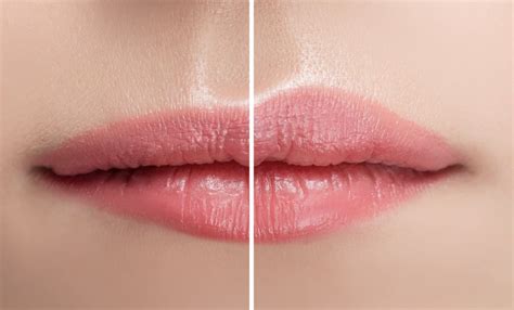 Lip Flip Before And After What Is Botox Lip Flip Lip Flip Toronto