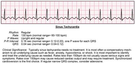 Ventricular Tachycardia Ecg