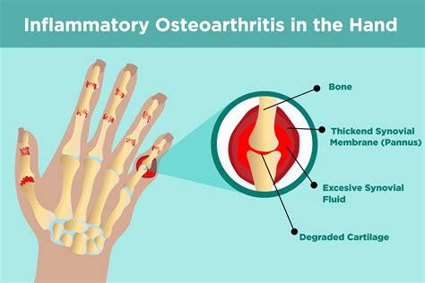 Osteoarthritis Nodules On Finger Joints