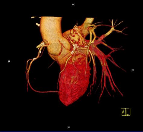 Coronary Ct Angiography Los Angeles Ca Cedars Sinai