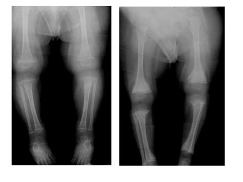 Diagnostic Imaging Of Osteopenia