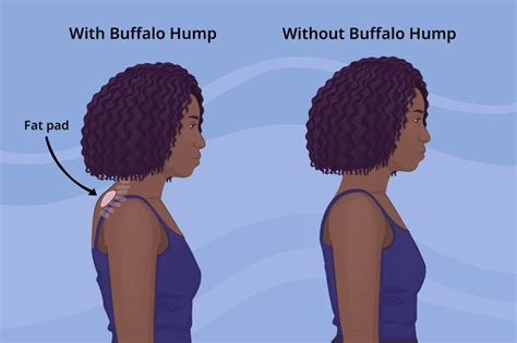 Neck Hump Causes Prevention And Solutions