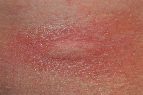 9 Leukemia Rashes Bruises And Other Skin Manifestations Page 7 Of 9