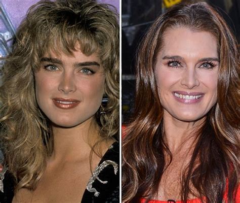 Brooke Shields Before And After Plastic Surgery 01 Celebrity Plastic