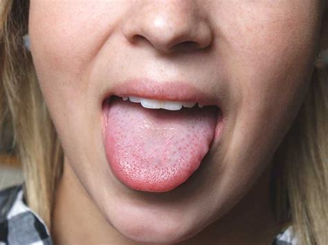 Top Home Remedies For Sore Tongue