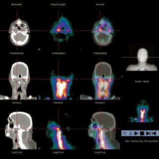 PDF Usefulness Of Hybrid SPECT CT For The 99mTc HMPAO Labeled