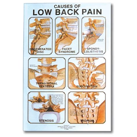 Buy Causes Of Low Back Pain Poster 24 X 36 Laminate