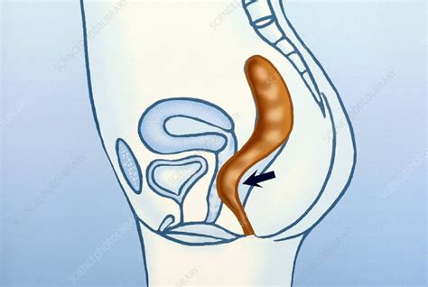Vaginal Wall Prolapse Artwork Stock Image C Science Photo Library