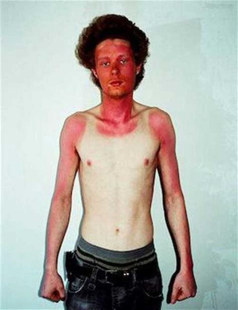 21 Insane Sunburns That Will Make You Fear The Sun Ouch Gallery Bad