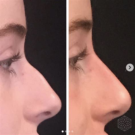 How to make sharp nose without plastic surgery is not easy and takes time and process. How to Get a Nose Job Without Surgery