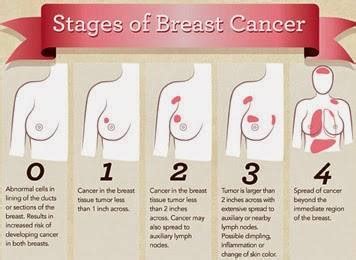 Kanker payudara adalah salah satu penyakit yang sangat berbahaya bagi kaum hawa.  KANSER PAYUDARA / BREAST CANCER Tahap... - Pusat ...