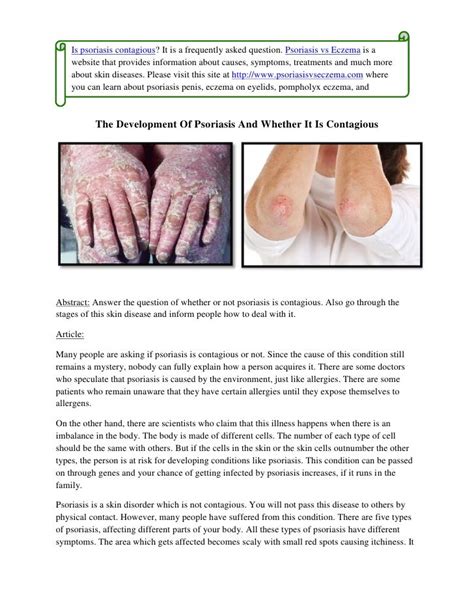 The Development Of Psoriasis And Whether It Is Contagious