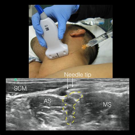 How To Implement Ultrasound Guided Nerve Blocks In Your Ed Acep Now