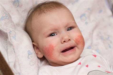 5 Types Of Skin Allergies In Babies Treatment And Prevention