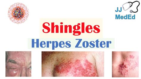 Shingles Herpes Zoster Pathophysiology Risk Factors Phases Of