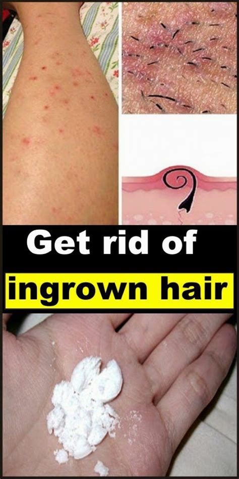 How To Get Rid Of Ingrown Hair Healthy Lifestyle