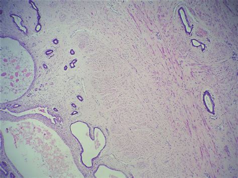 Cervix Mild Chronic Inflammatory Infiltrate In Mucosal Lamina Propria