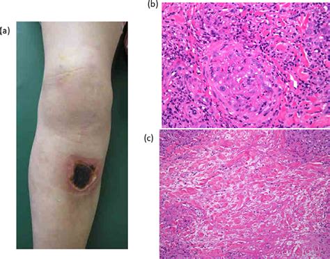 A Necrotic Ulcer With Reddening Of The Circumjacent Skin At The
