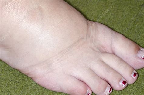 foot swelling in late pregnancy stock image c013 5839 science photo library