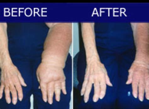 Lymphedema Therapy Call 301 588 3929 Arso Neuro Rehab And