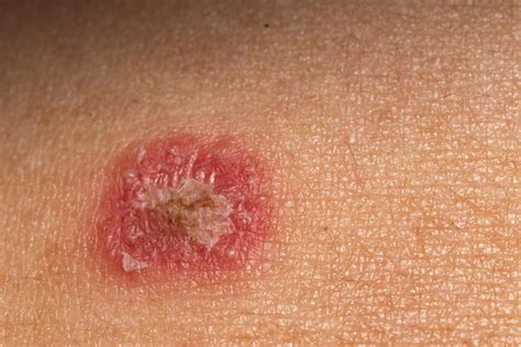 Pictures Skin Rashes Like Ringworms