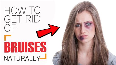 How To Get Rid Of Bruises Quickly Home Remedies For Bruises Treatment Youtube