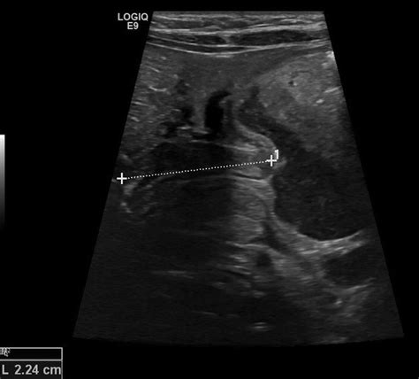 Pyloric Stenosis Ultrasound