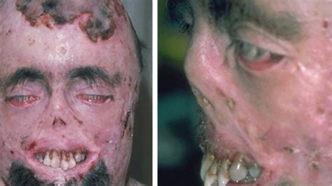 10 Most Disgusting Diseases In The World You Cant Imagine