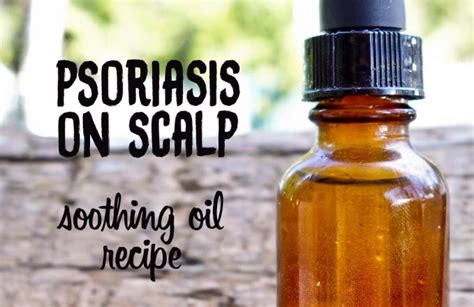 Psoriasis On Scalp Try This Soothing And Moisturizing Diy Recipe