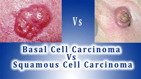 Basal Cell Carcinoma Vs Squamous Cell Carcinoma Bcc Vs Scc Hot Sex