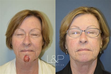 Reconstructive Surgery Before And After Photos Case 44 Palo Alto