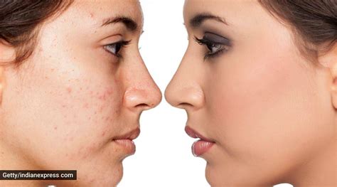 Basic Skincare Some Everyday Habits That Can Cause Acne Life Style